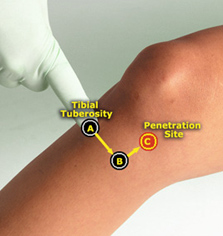 Adult Injection Site