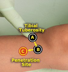 Pediatric Injection Site