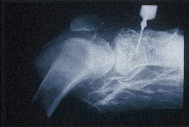X-Ray of Injection Site